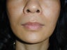 Radiesse in smile lines (Nasolabial Folds)