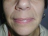 Restylane for smile lines (nasolabial folds)