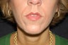Nasal labial folds treatment with Evolence