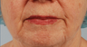 Perlane to the Lower Face