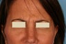 Frown lines treatment