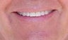 Zoom whitening