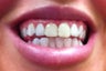 Zoom Whitening