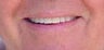 Zoom whitening