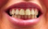 Zoom Whitening