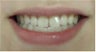 Zoom! Laser Whitening