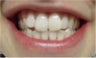 Zoom! Laser Whitening
