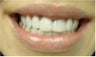 Zoom! Laser Whitening