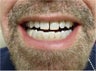 Zoom! Laser Whitening