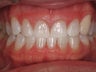 Tooth Whitening