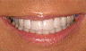 Whitening
