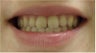 Zoom! Laser Whitening