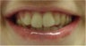 Zoom! Laser Whitening