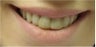 Zoom! Laser Whitening