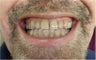 Zoom! Laser Whitening