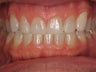 Tooth Whitening