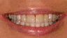 Whitening