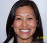Porcelain Veneers