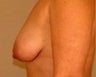 Mastopexy (Breast Lift)