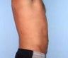 Liposuction