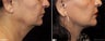 Facelift