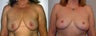 Breast Lift