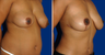 Breast Lift