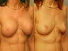 Breast Lift and Reduction