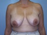 Vertical Breast Lift
