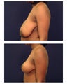 Breast Reduction & Lift