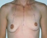 Breast Lift