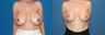 Breast Lift