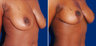 Breast Lift