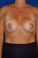 Mastopexy lift, Augmentation