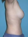 Abdominoplasty and Breast Augmentation