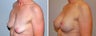 Breast augmentation and lift