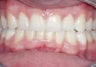 Invisalign