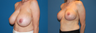 Breast Lift