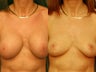 Breast Lift and Reduction
