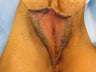 Labia Reduction Surgery