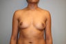 Gummy Bear Breast Implants