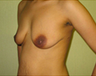 Breast Lift