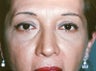 Lower Blepharoplasty & Laser Skin Resurfacing