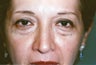Lower Blepharoplasty & Laser Skin Resurfacing