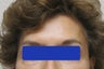 60 year old female treated with Botox for forehead lines