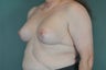 Breast Lift
