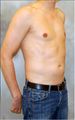 Male Poland Syndrome