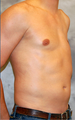 Male Poland Syndrome