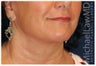 Lower Facial Rejuvenation