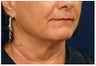 Lower Facial Rejuvenation
